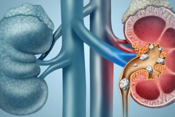 Methods of treatment to remove kidney stones Methods of treatment to remove kidney stones