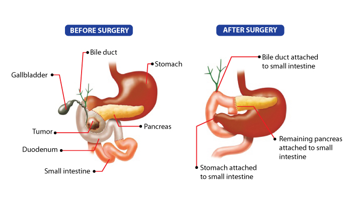 Whipple Surgery Offers Hope And Potential Cure For Pancreatic Cancer Whipple Surgery Offers Hope And Potential Cure For Pancreatic Cancer