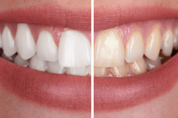 Teeth-whitening-all-you-should-know teeth whitening