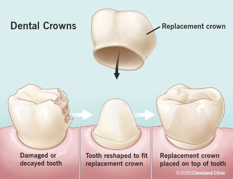 A Guide To Dental Crown: Cap Your Tooth, Uncap Your Smile