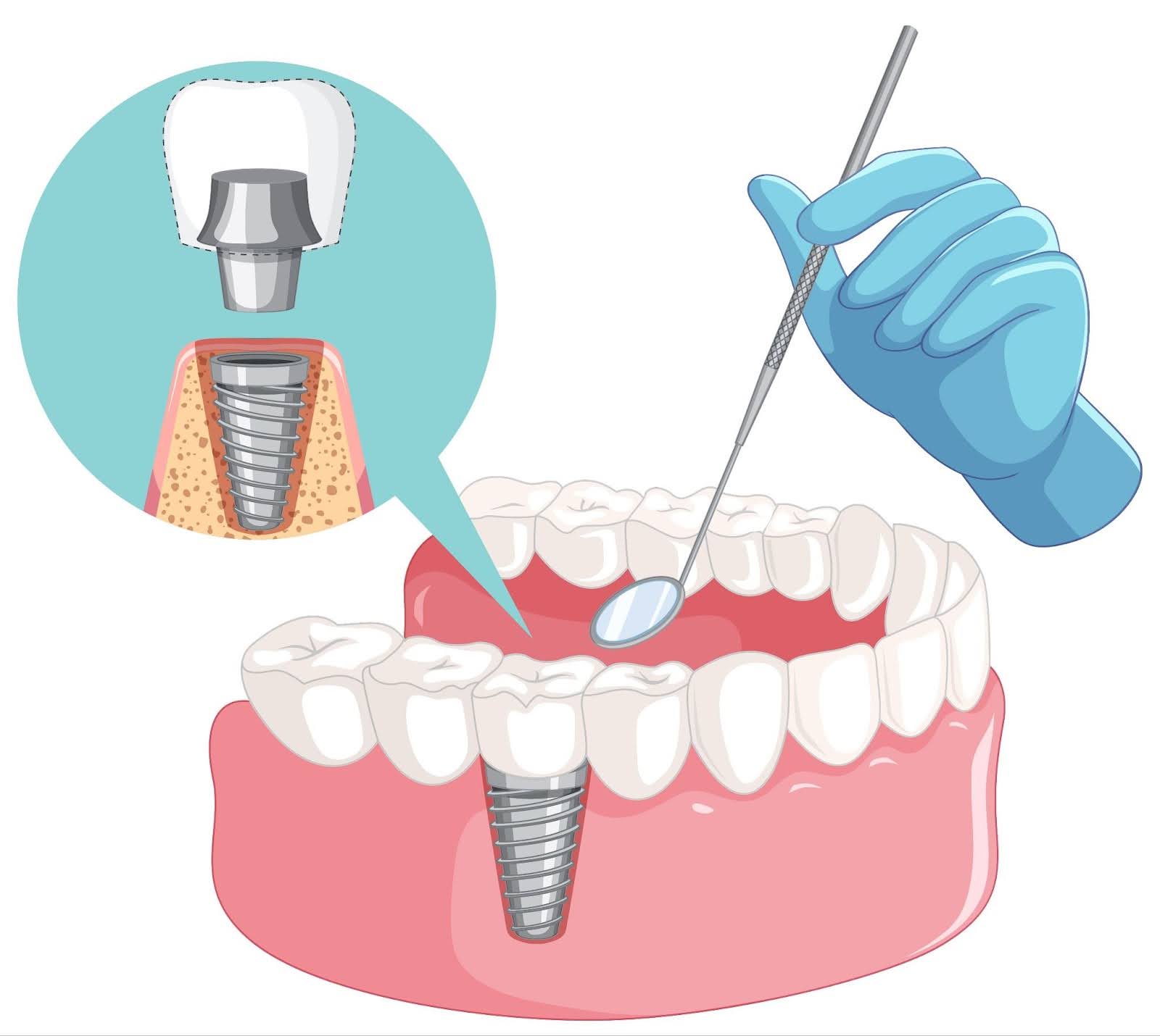 Endosteal implants