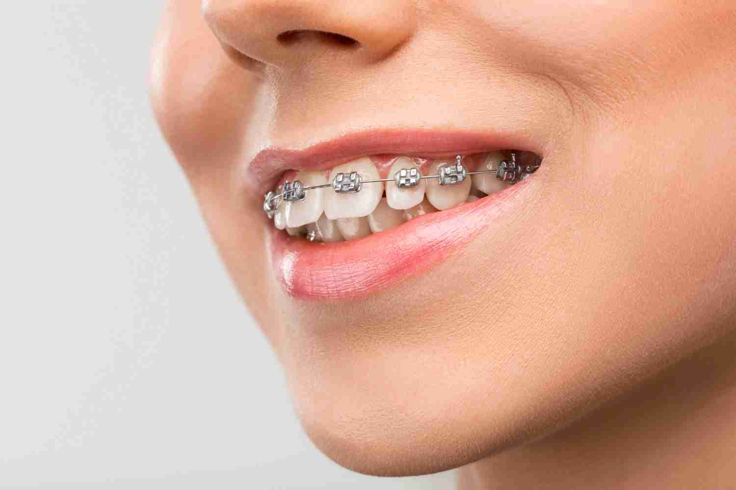 Image of conventional braces