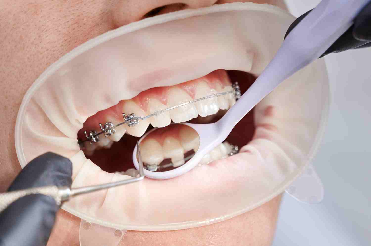 Image of Conventional Braces