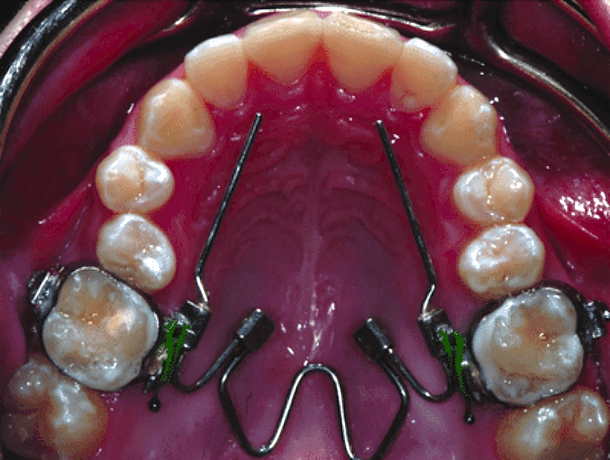 Image of palatal expander