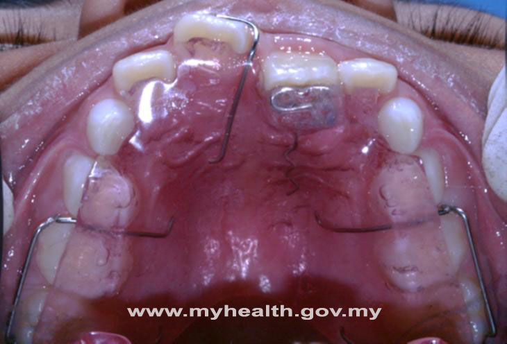 Image of palatal expander