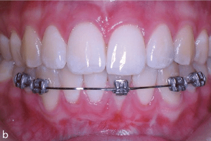 Image of partial braces