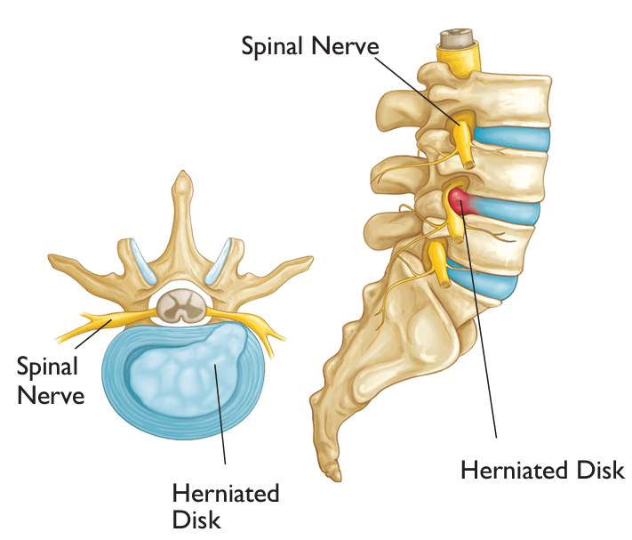 Image of slipped disc