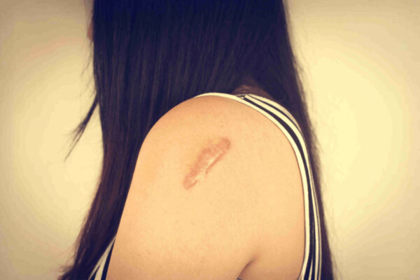 keloid-treatment-women-arm