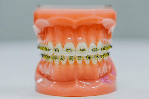 braces