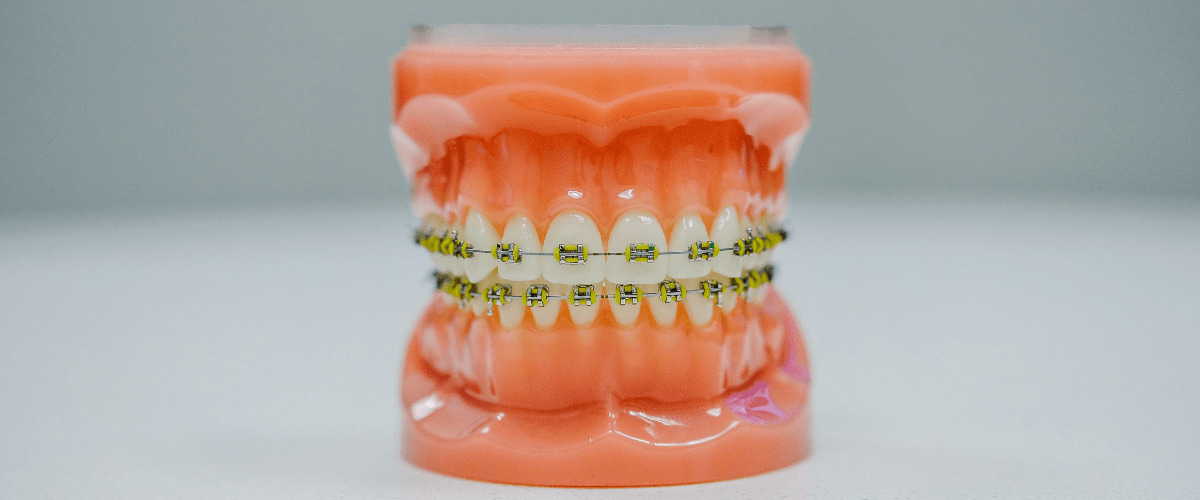 braces