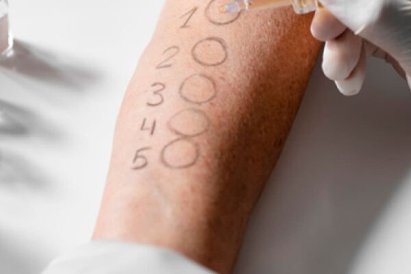 allergy-test
