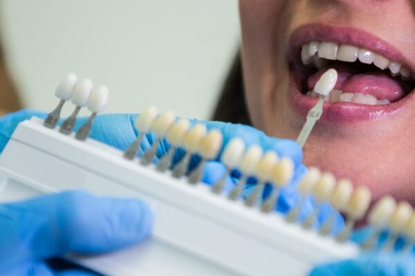 Dental-Crown_header