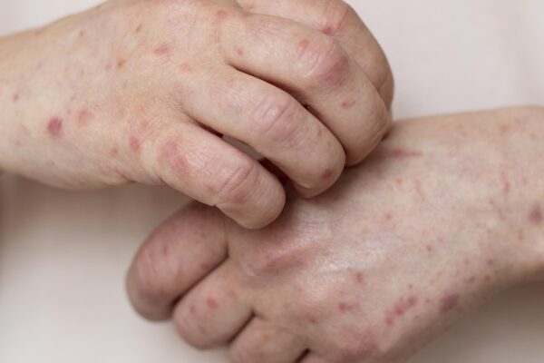 chicken pox chicken pox