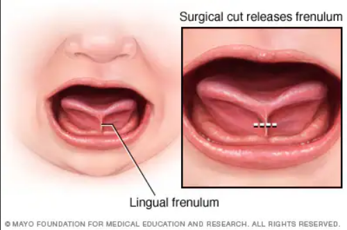 Infant frenotomy