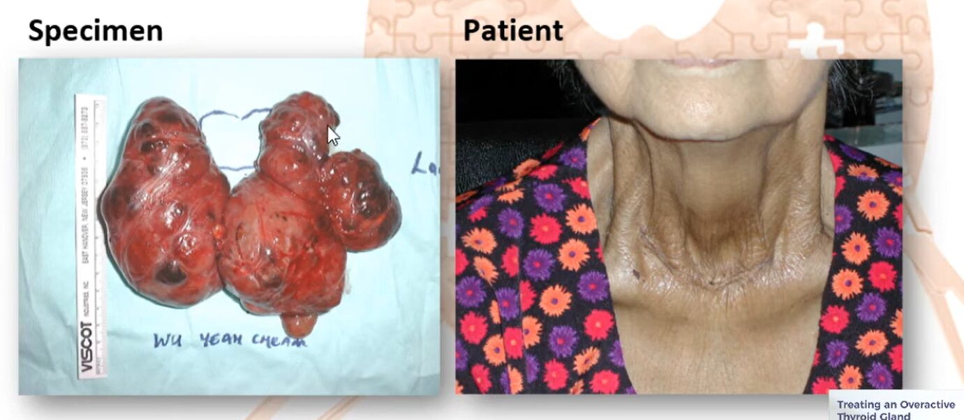 Photo of Patient after surgical removal of the thyroid