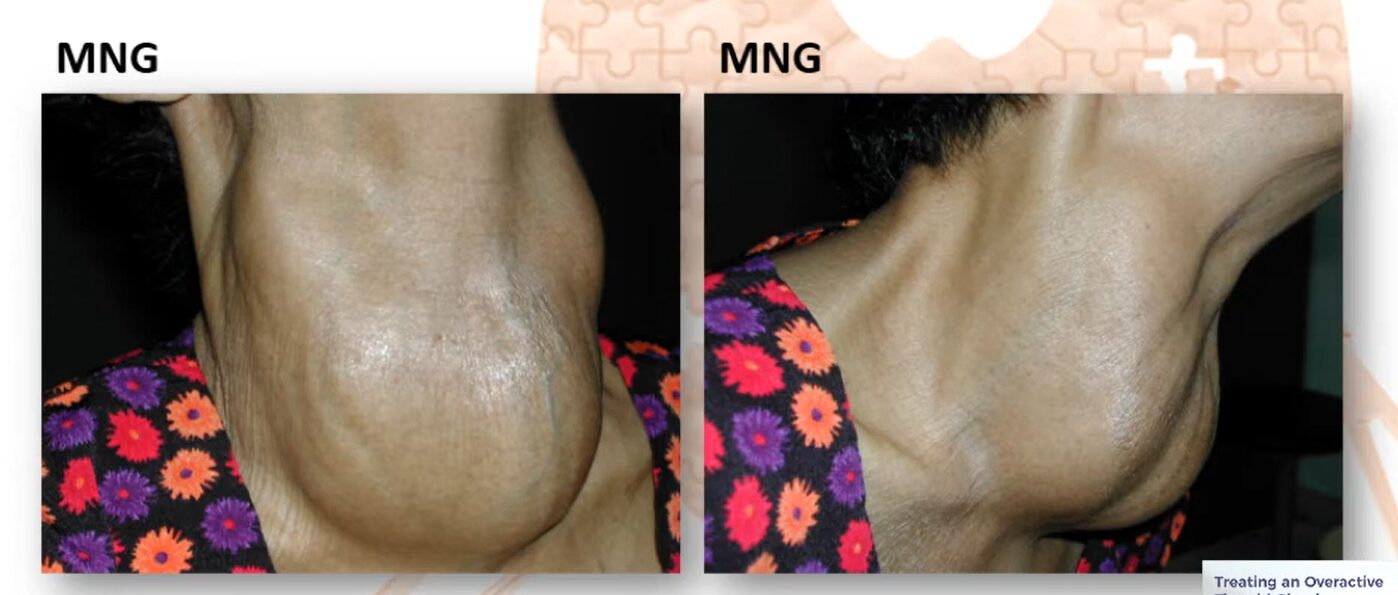 Photo of patient with multinodular Goitre (MNG)