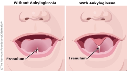 Normal tongue vs Tongue tie tongue