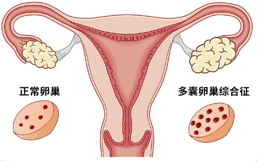 多囊卵巢综合征图表