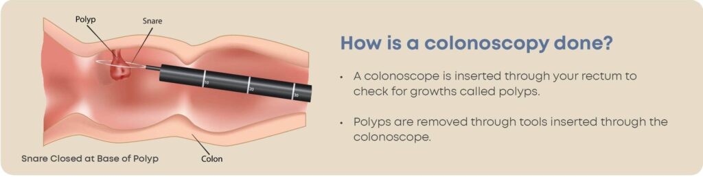 Diagram Showing How Colonoscopy is Done