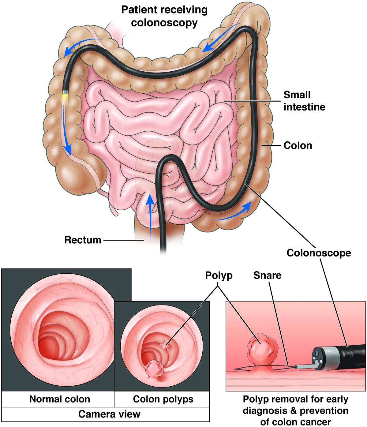 Diagram showing colonoscopy scoping