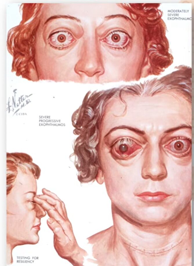 Illustration of thyroid eyes