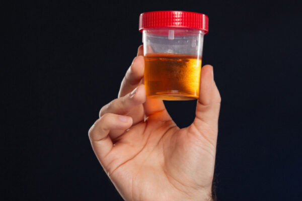 Blood in urine (Hematuria) 2026