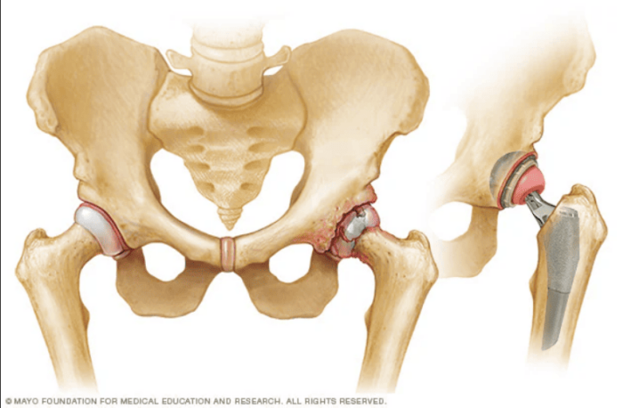 8 Things You Need to Know About Getting Hip Replacement Surgery in Malaysia