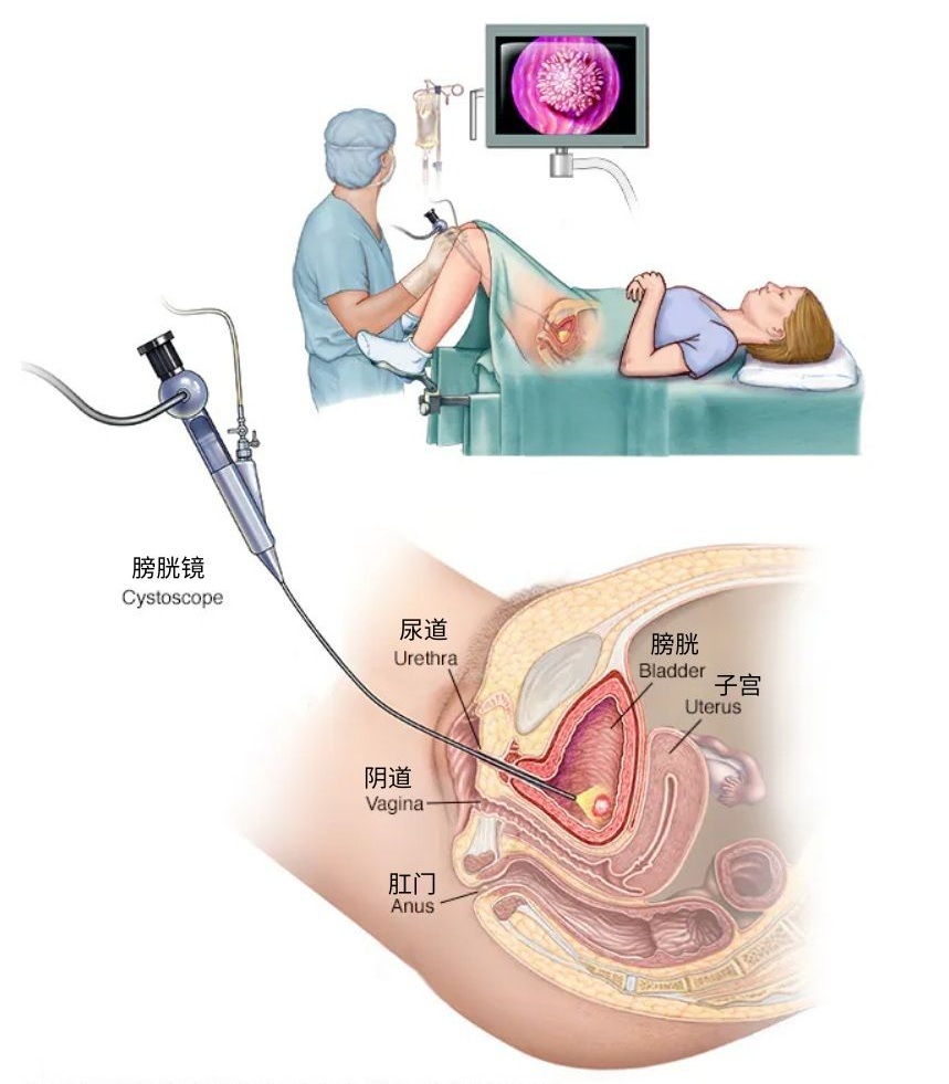 Female Cystoscopy