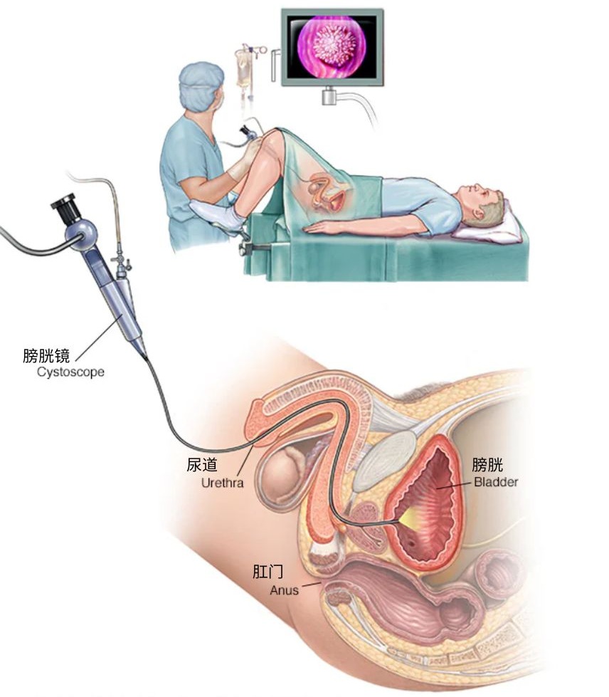 Male Cystoscopy